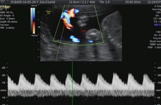 Flussimetrie Doppler Flussimetrie Doppler